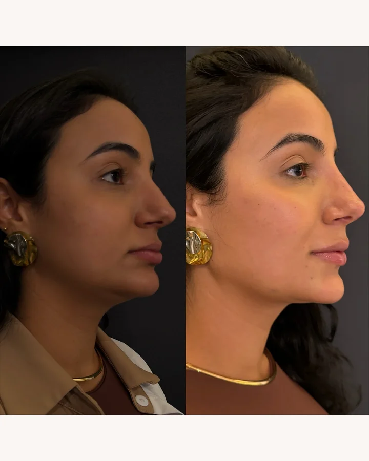 Resultado antes e depois 5